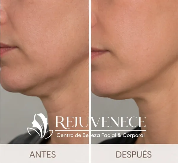 Rejuvenecimiento facial Botox
